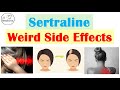 Sertraline Zoloft Weird Side Effects Hair Skin Vision Etc