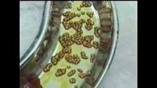Gall Stones 196.wmv