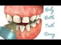 Baby Bottle Tooth Decay Nursing Bottle Caries Shorts