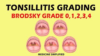 Tonsillitis Grading | Brodsky grading scale  (Grade 0,1,2,3,4) #medicine