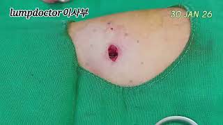 팔꿈치에 발생한 커다란 혹