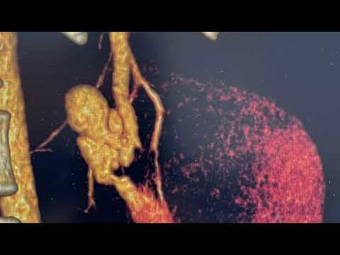 Эмболизация при остром кровотечении