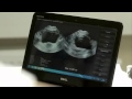 Vitascan LT USB Ultrasonic Bladder Scanner