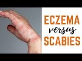 Scabies vs. Eczema: Causes, Symptoms & Treatments