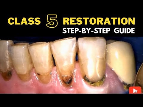 Class V Composite Restoration Procedure Guide