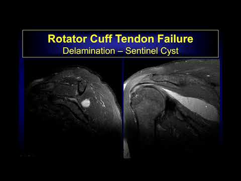 Imaging findings of Rotator cuff