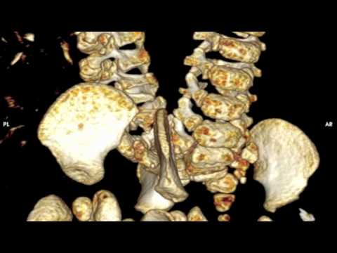Le Bonheur Children's Hospital Conjoined Twins 3D Imaging