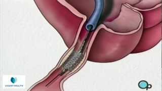 Stent Implantation Coronary Angioplasty Vidant PreOp® Patient Education