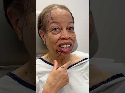 Full Facial Rejuvenation Takes 20 Years Off - INSANE BEFORE AND AFTER 🤯