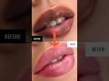 Black to Pink lips naturally at home | Lip pigmentation removal lip balm # #ashortaday #trending