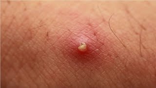 how to get rid of pus filled pimples overnight