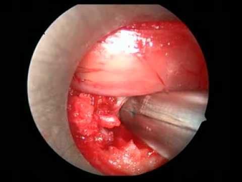 L5-S1 Endoscopic Slipped Disc Removal 