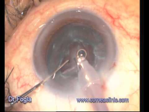 Phacoemulsification with Foldable Intraocular Lens Implantation Under Topical Anesthesia