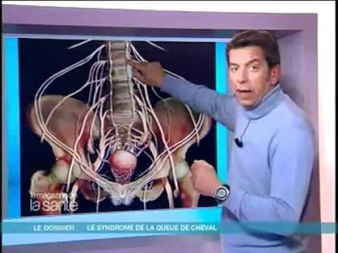 comment soigner le syndrome de lhermitte