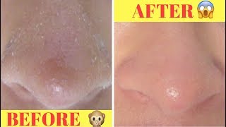 DIY: 5 minute DRY SKIN ON NOSE RECIPE‼️