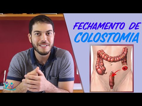 súlycsökkenés ileostomia után