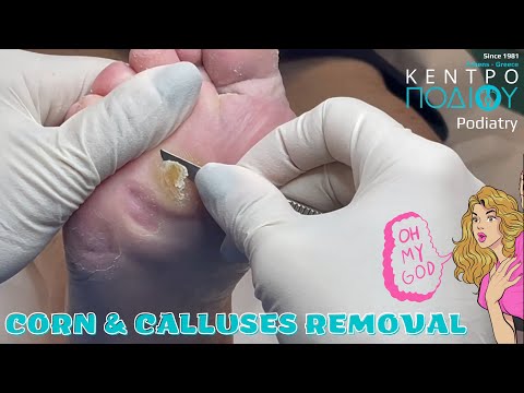 Corn & Calluses #kentropodiou #callus #κεντροποδιου #footcare #podologos #podiatrist  #podiatry