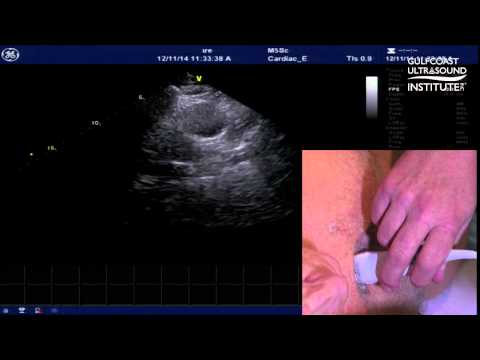 Hot Tips - Obtaining a Right Parasternal Cardiac Window