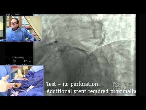 Complex PCI Case Study: Part 3 - Stent Deployment with Guide Support