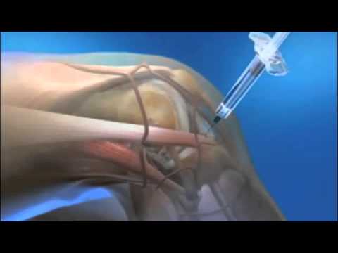 Learn More About Euflexxa Injections