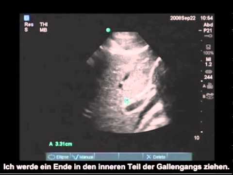 Brust-Osteochondrose 23 Die Rückenschmerzen in Osteochondrose mit Volksmittel zu entfernen