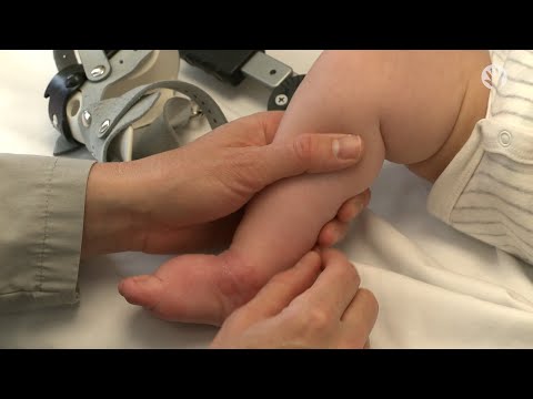 Clubfoot Stretches | Common Issues | Module 5
