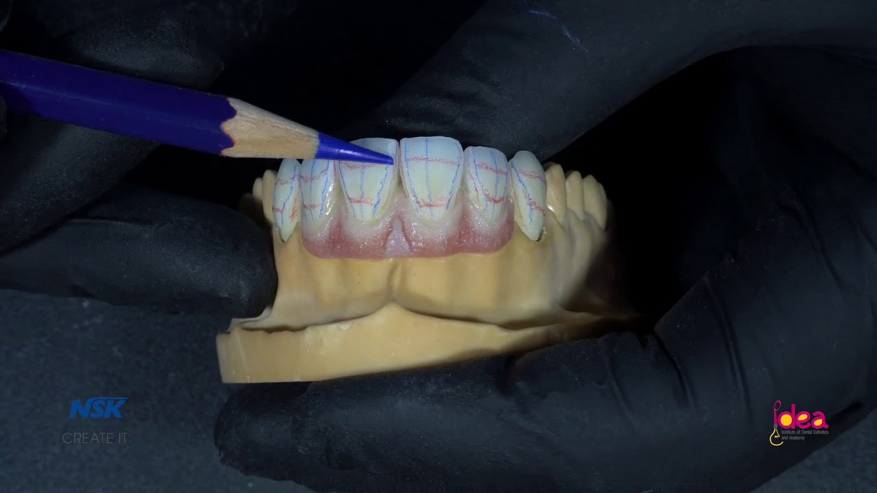 Un détartrage avec un micromoteur