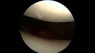 ViewInsidetheKneeDuringACLSurgery