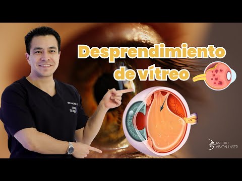 Desprendimiento de Vítreo