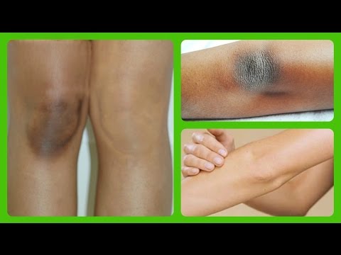 LIGHTEN DARK KNEES AND ELBOWS QUICK & NATURALLY AT HOME Video