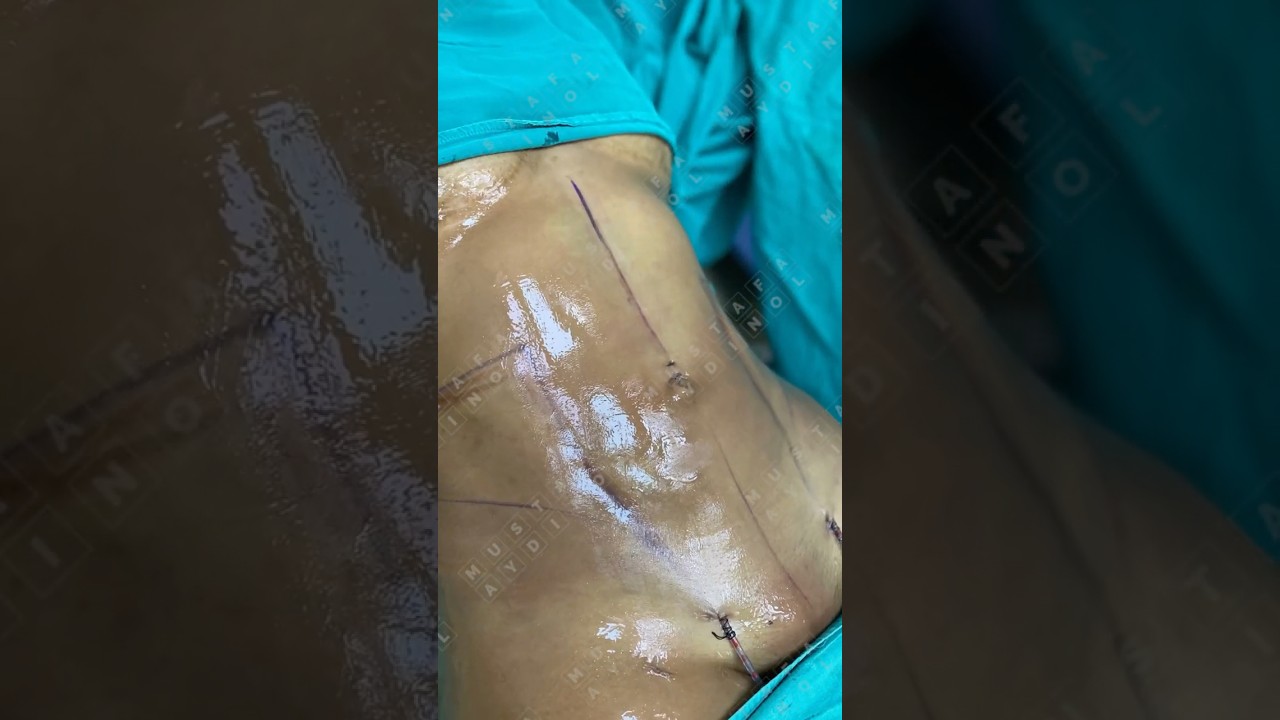Remodelage corporel par liposuccion