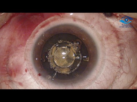 Logo of Affordable Cataract Surgery and IOL Implantation in Tijuana – What to Know