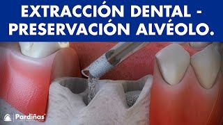 Extracciones dentales - Tratamiento para preservar el alvéolo © 