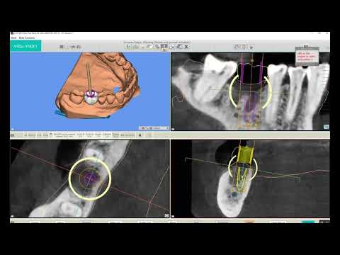 MSOFT Tutorial: Implant Design (Part 6)