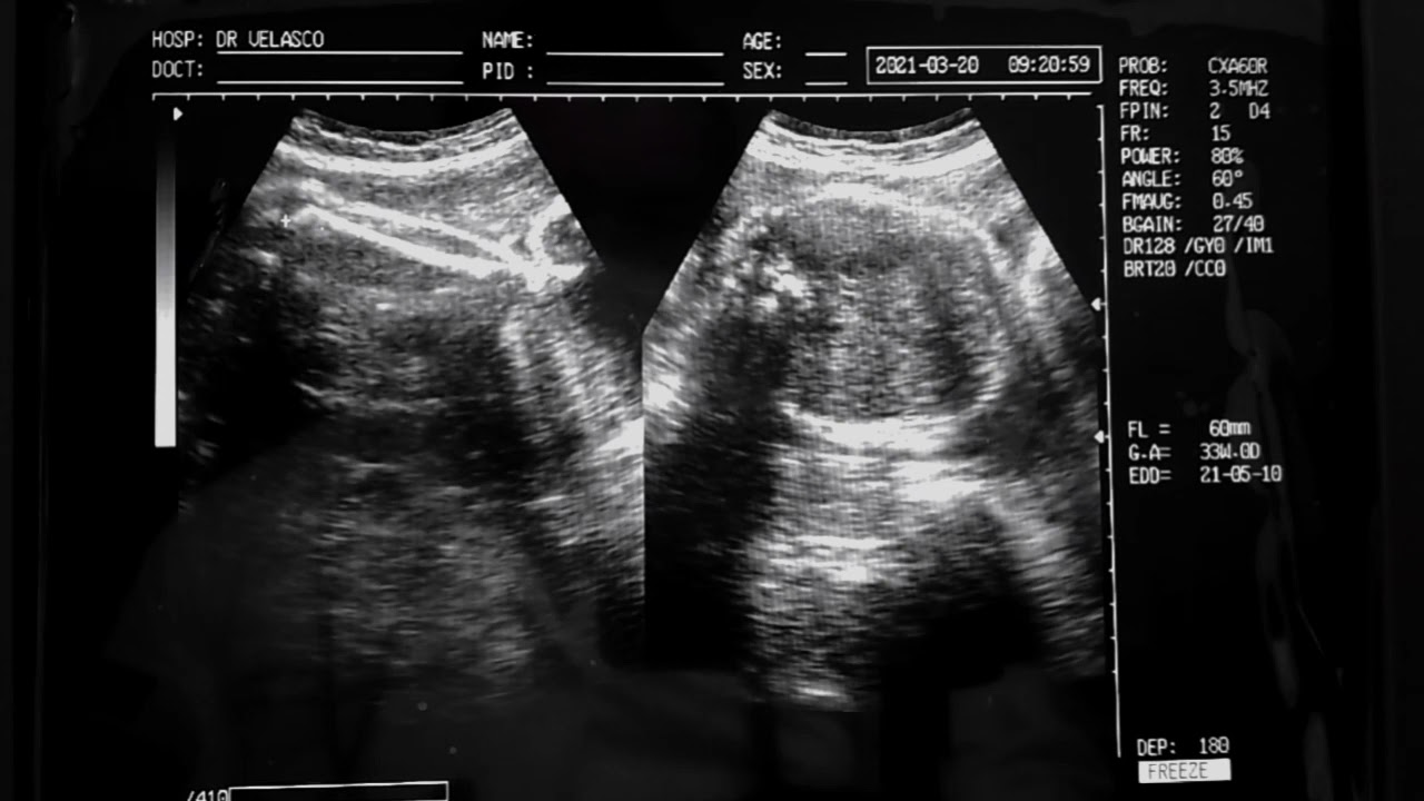 Watch ECOGRAFÍA 32 SEMANAS DE GESTACIÓN FETO DE 32 SEMANAS 8 MESES DE EMBARAZO Now ECOGRAFÍA 32 SEMANAS DE GESTACIÓN FETO DE 32 SEMANAS 8 MESES DE EMBARAZO