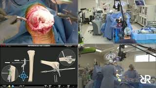 Dr.  Stefan Kreuzer Performs Total Knee Arthroplasty using Corin OMNIBot (No Audio)