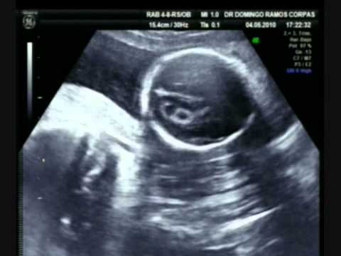 Watch video Síndrome de Down: diagnóstico fetal