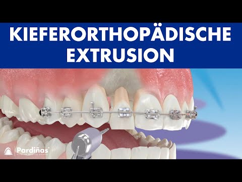 Kieferorthopädische Extrusion ©