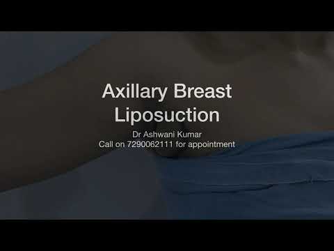 Patient Recovery Case — Video 5 (Tummy Tuck)