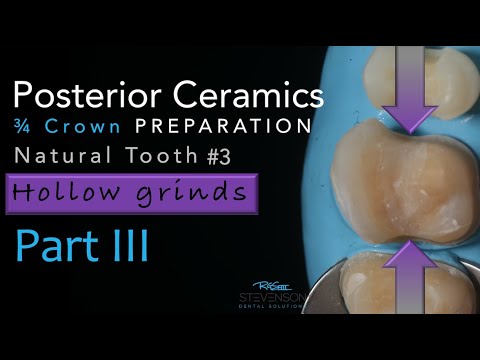 Zirkonoxidkeramik, Teil 3: Dreiviertelkronenpräparation – Hohlschliff