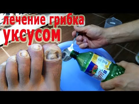 Von welchen Tabletten man gribok der Nägel auf den Beinen heilen kann Gribok der Nägel auf den Beinen die Behandlung von den Volksmitteln Videos