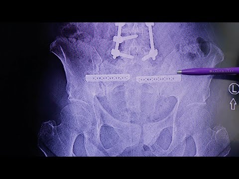 Dr. Desai explains SI Fusion