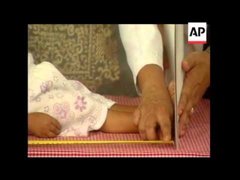 A poor Filipino blacksmith's son was declared the world's shortest man on his 18th birthday. Guinnes