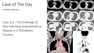 Case of the Day - 121 - 2025 10 28 - Challenge of Non-Necrotizing Granulomatous Disease vs TB
