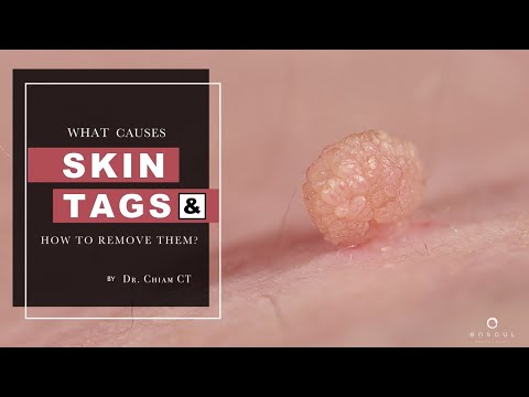 Skin Tags, Seborrheic Keratosis & Warts | What's the difference? - Dr Chiam CT