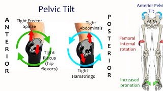how to fix anterior pelvic tilt in one day
