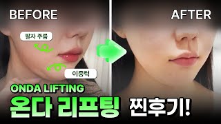 [Eng] 팔자 주름, 이중턱 삭제 시키는 온다 리프팅!  상담부터 시술 후기까지! Erase Smile Lines and Double Chin with ONDA Lifting!