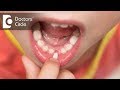 Why do children's teeth fall out? - Dr. Raju Srinivas