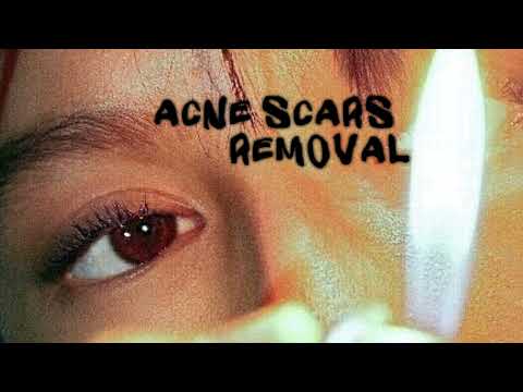 acne scars removal