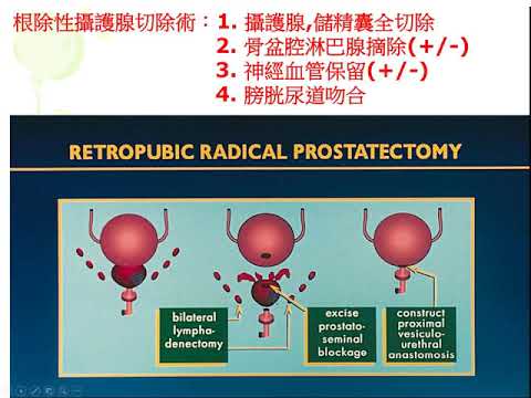 2020年12月攝護腺癌病友會--「攝護腺癌術後排尿障礙診治」(李建儀醫師)